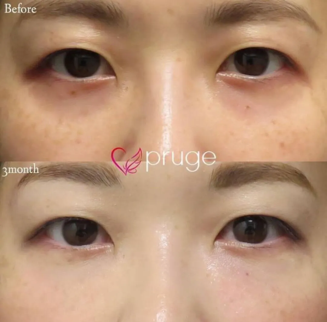 PRP注射（目の下）