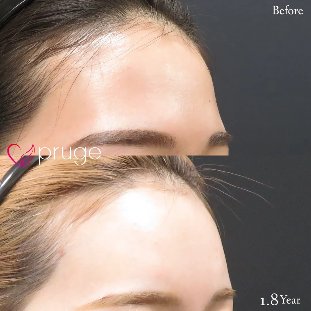 額の傾斜・凹み