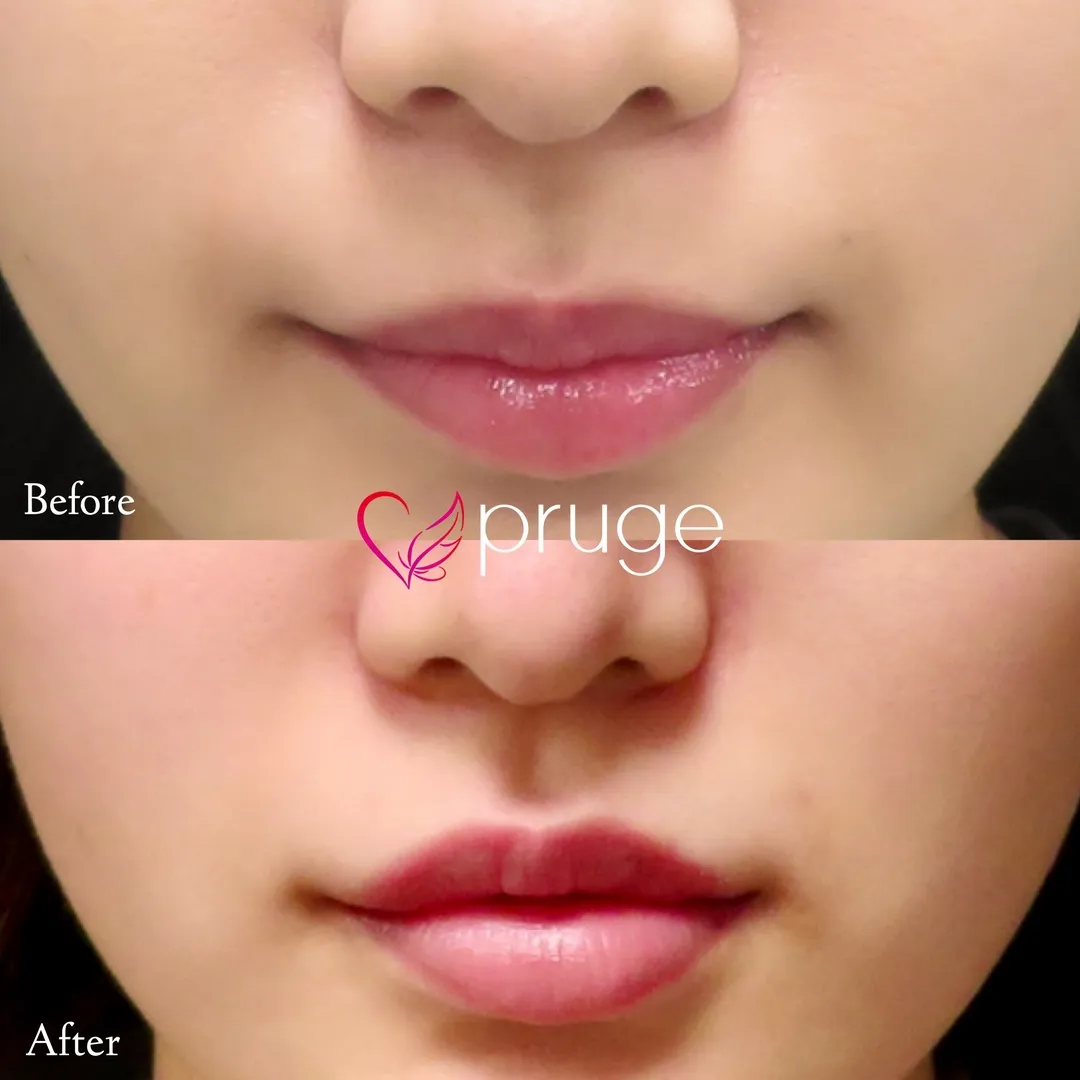 唇のボリュームアップ