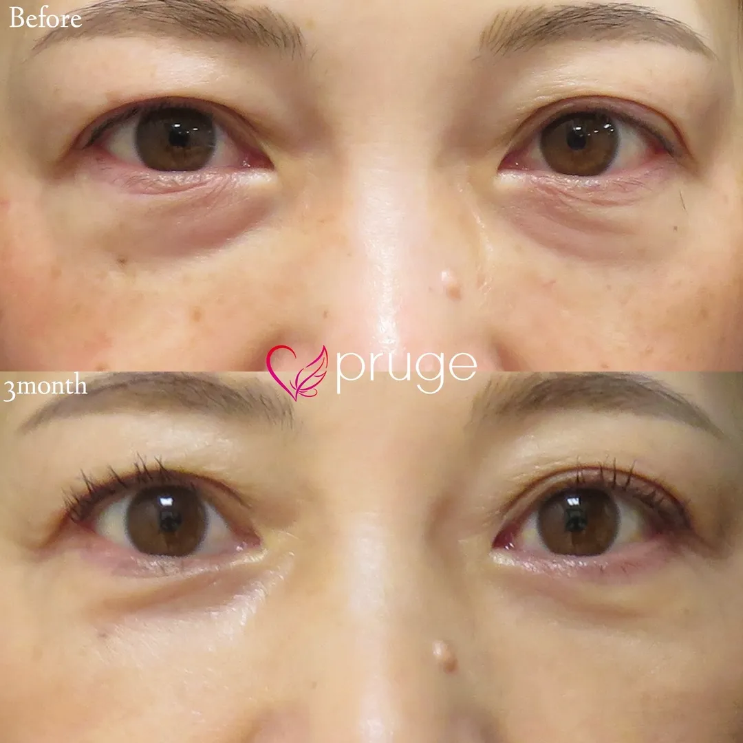 PRP-MI脱脂術、PRP注射（目頭）