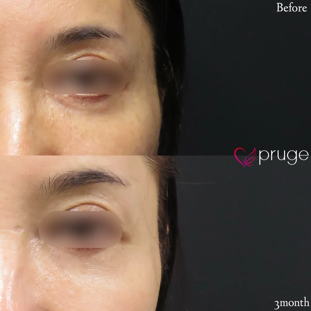 PRP注射（こめかみ凹み）