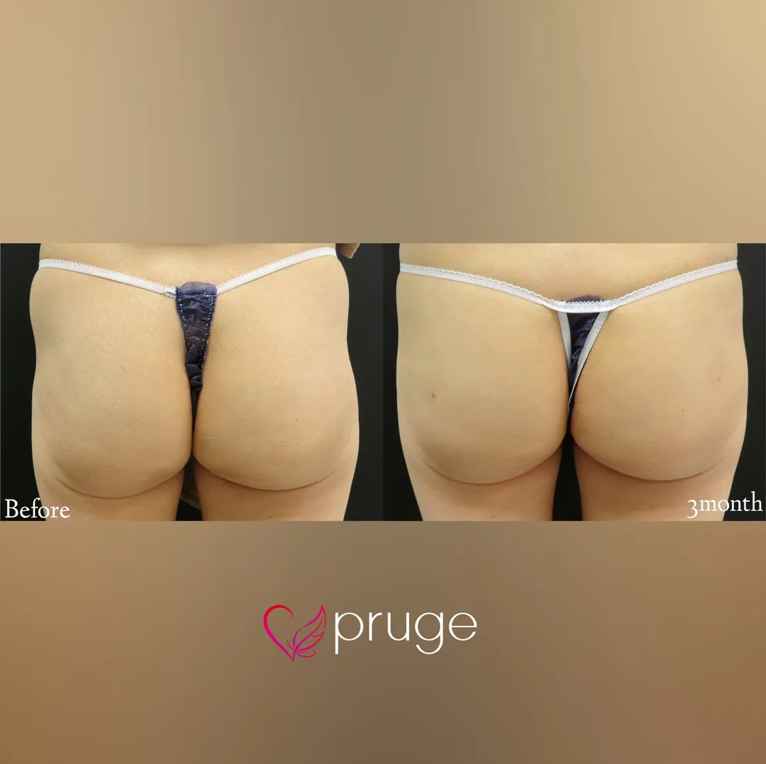 PRP注射によるヒップ形成