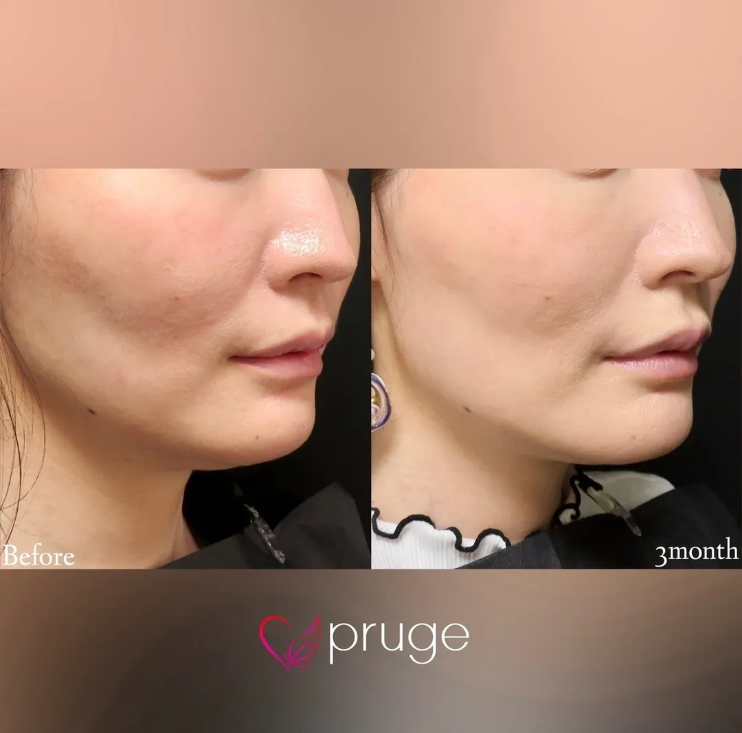 PRP注射（ホホのコケ）