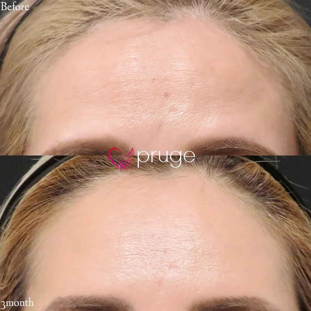 ひたい・こめかみ丸み形成