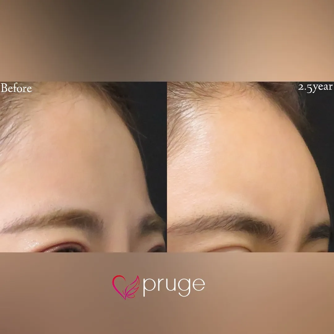 ひたい・こめかみ丸み形成