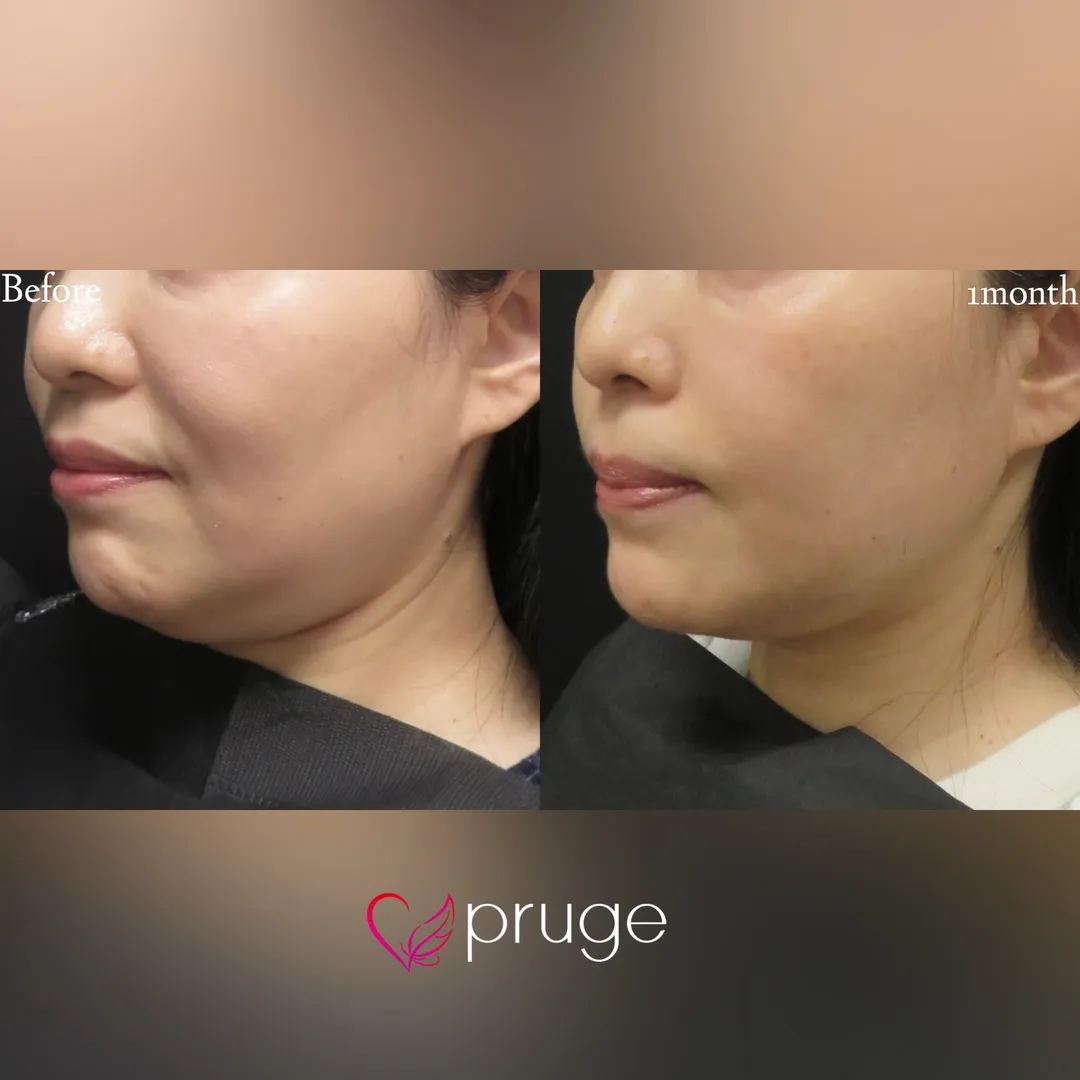 pスリム注射（あご下）