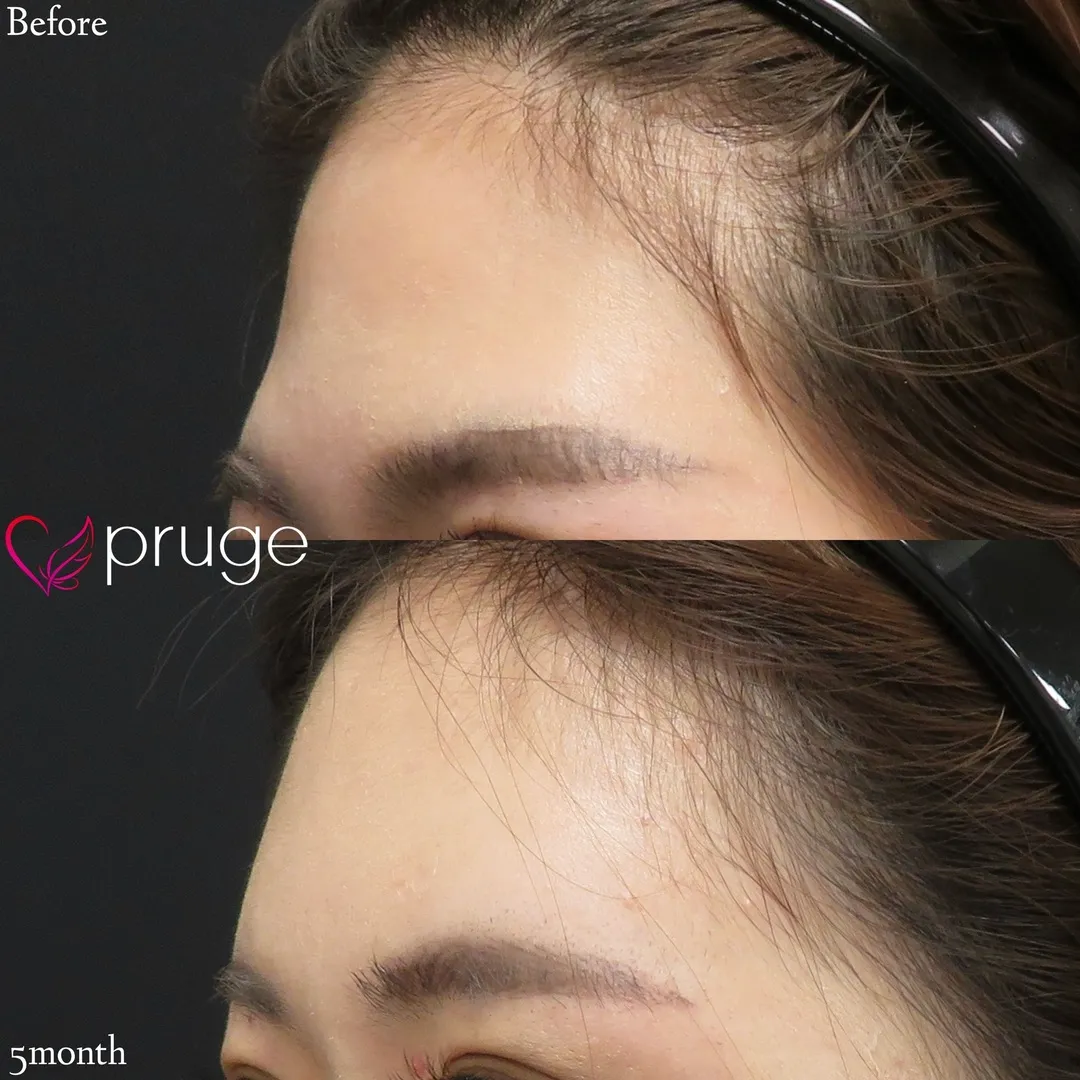 ひたい・こめかみ丸み形成