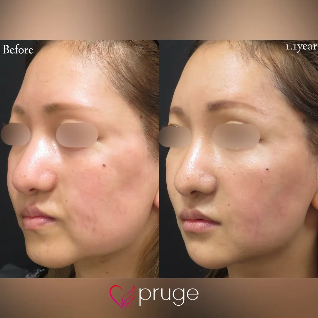 ロンバーグ病に対するPRP注射