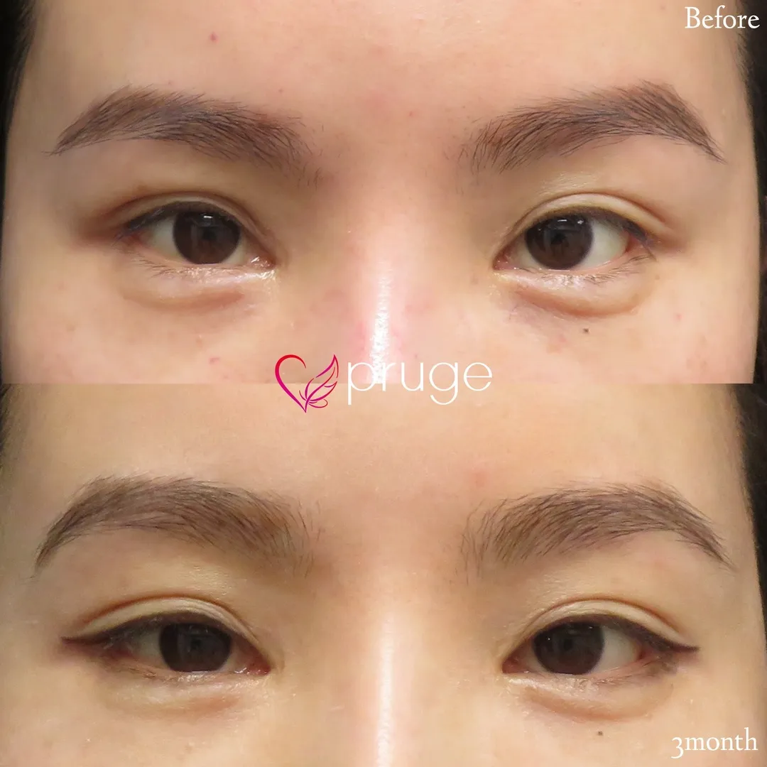 PRP注射(二重幅拡張)