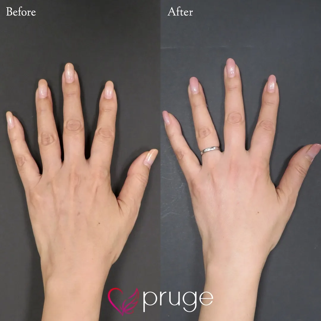 手の甲のスジ・乾燥