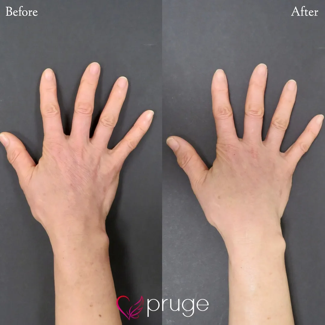 手の甲のスジ・乾燥