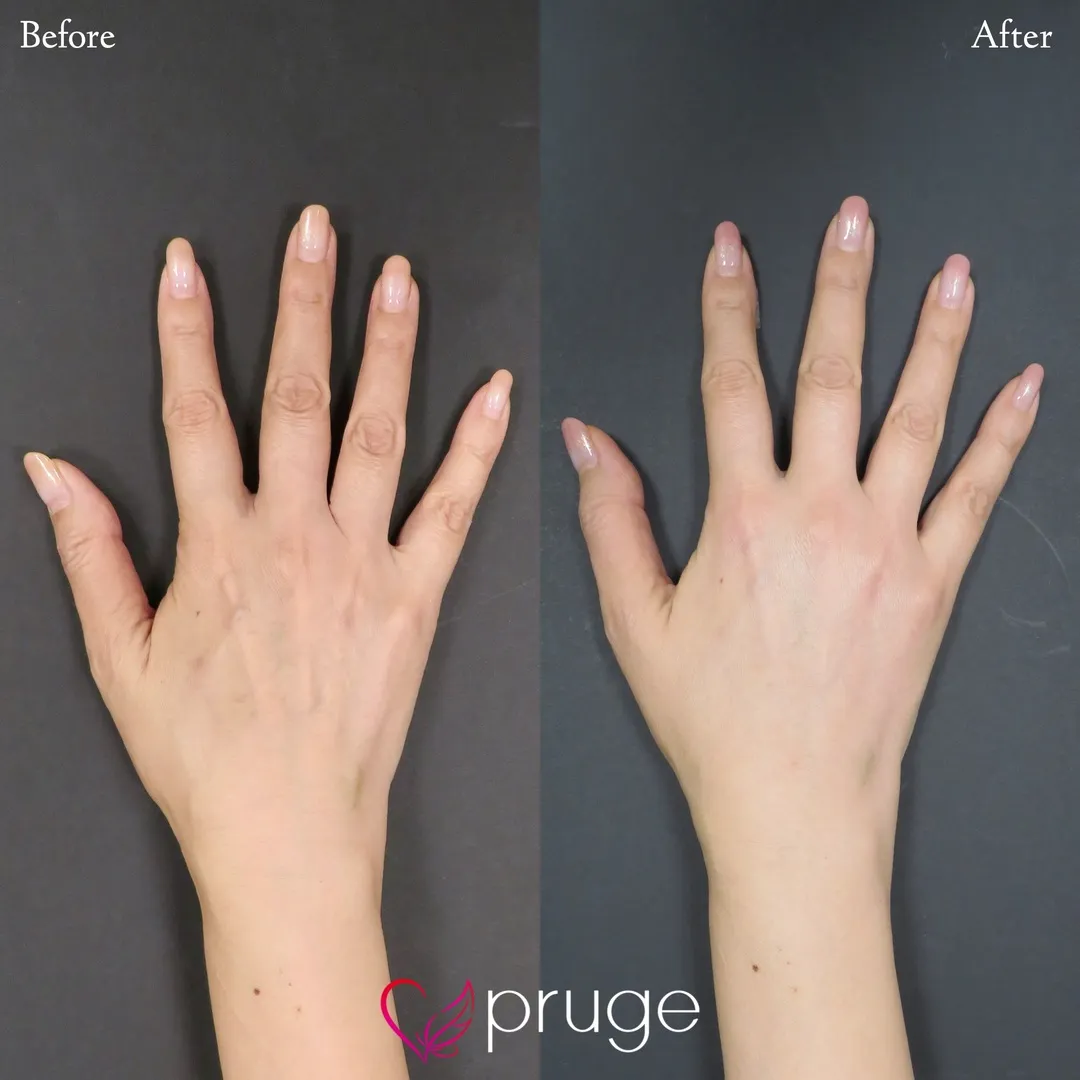 手の甲のスジ・乾燥