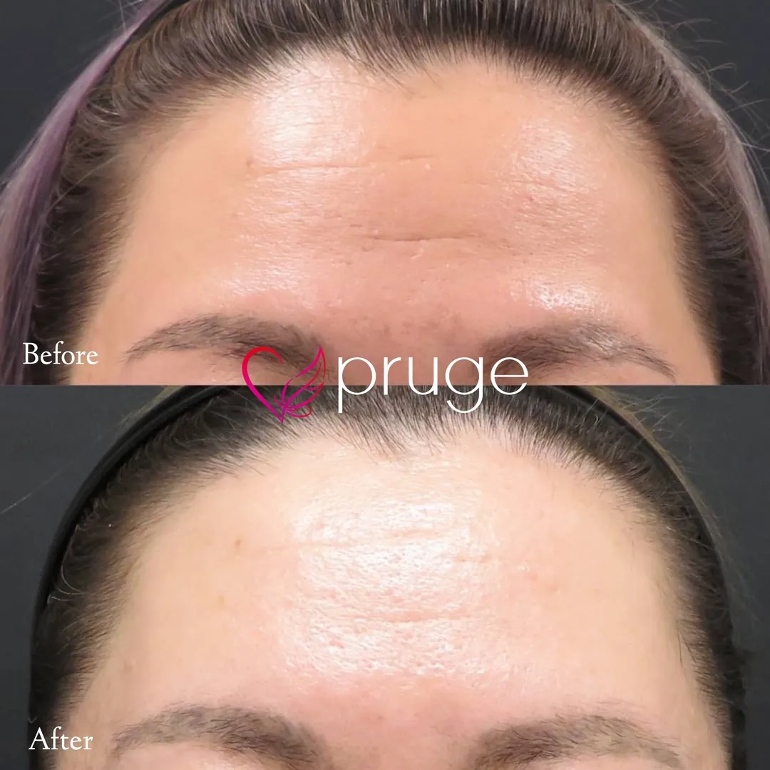 額の傾斜・額のシワ