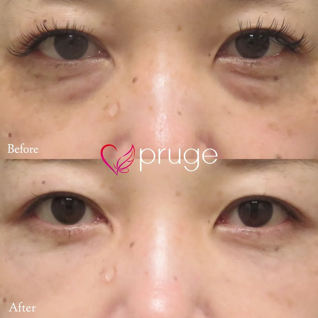 目の下のクマ・ふくらみ