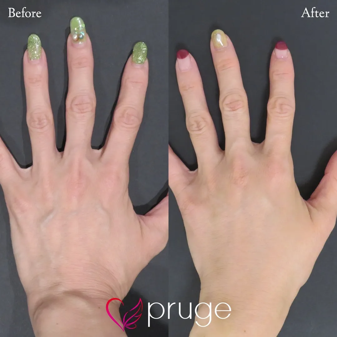 手の甲のスジ・血管