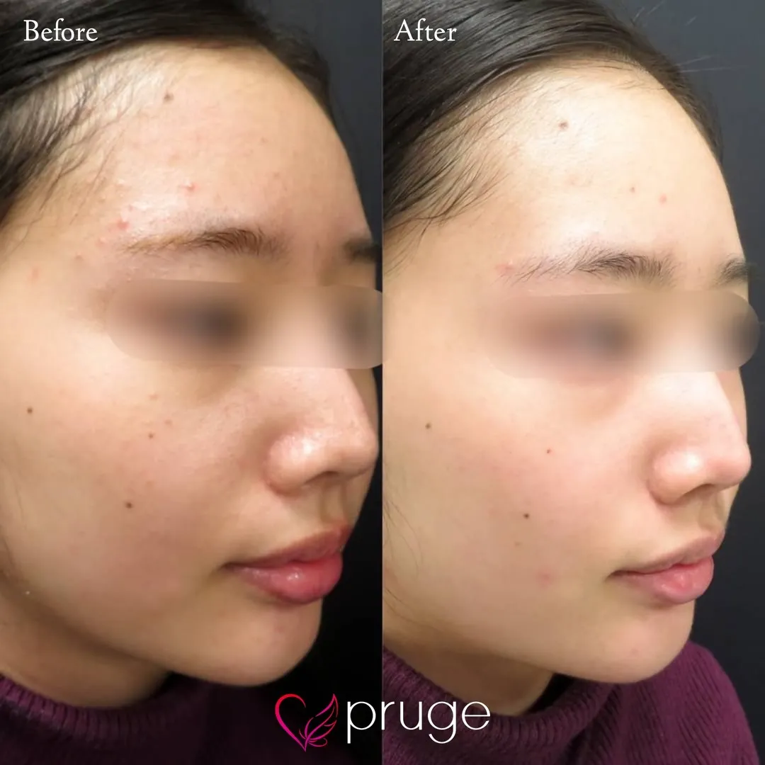 ヴァンパイアフェイシャル（全顔）