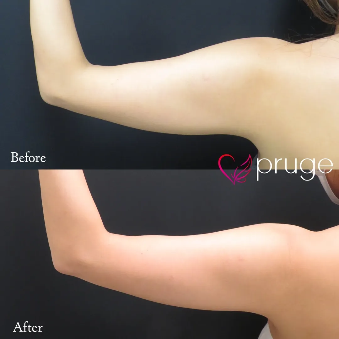 二の腕のたるみ