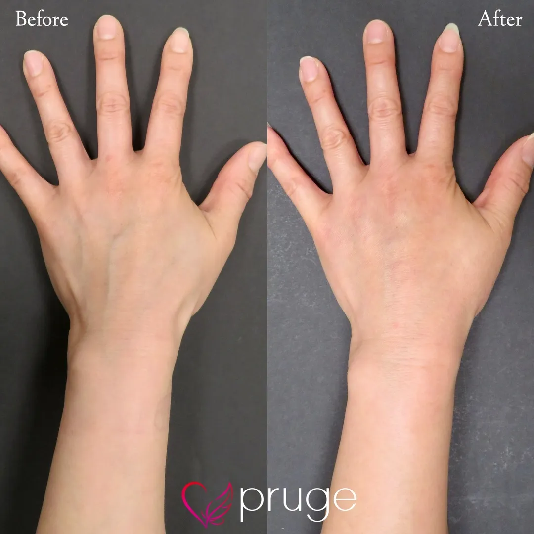 手の甲のスジ・乾燥