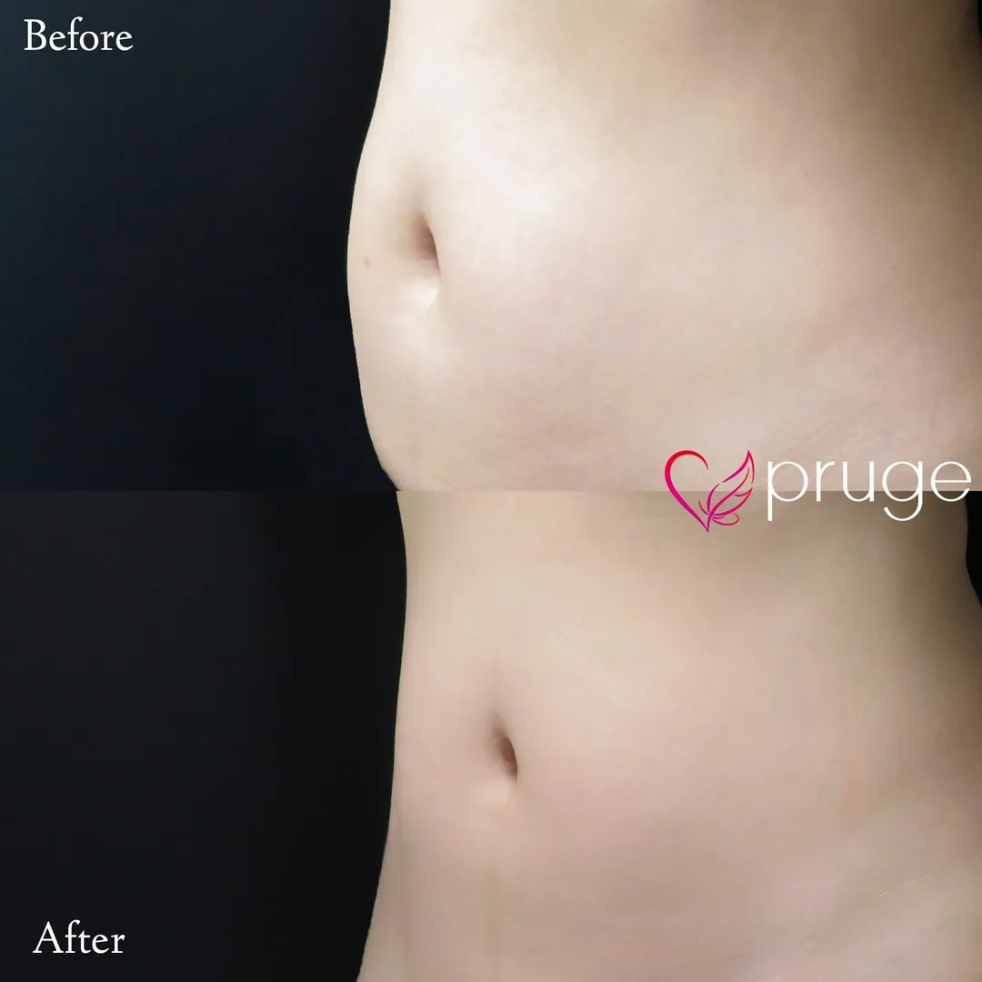 Pスリム注射（お腹）