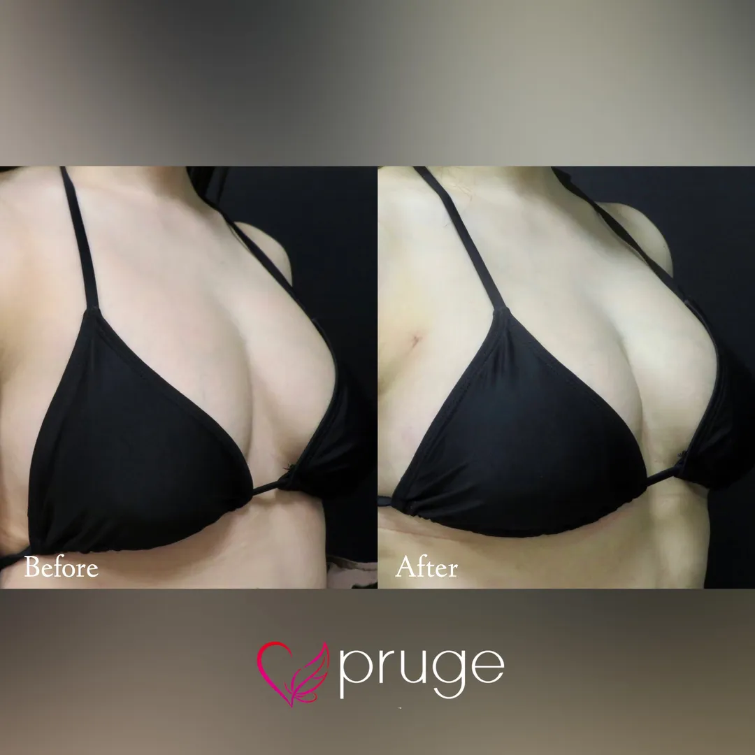 PRP注射（お胸）