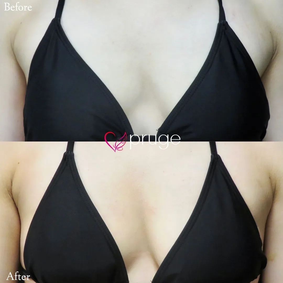 PRP注射（お胸）