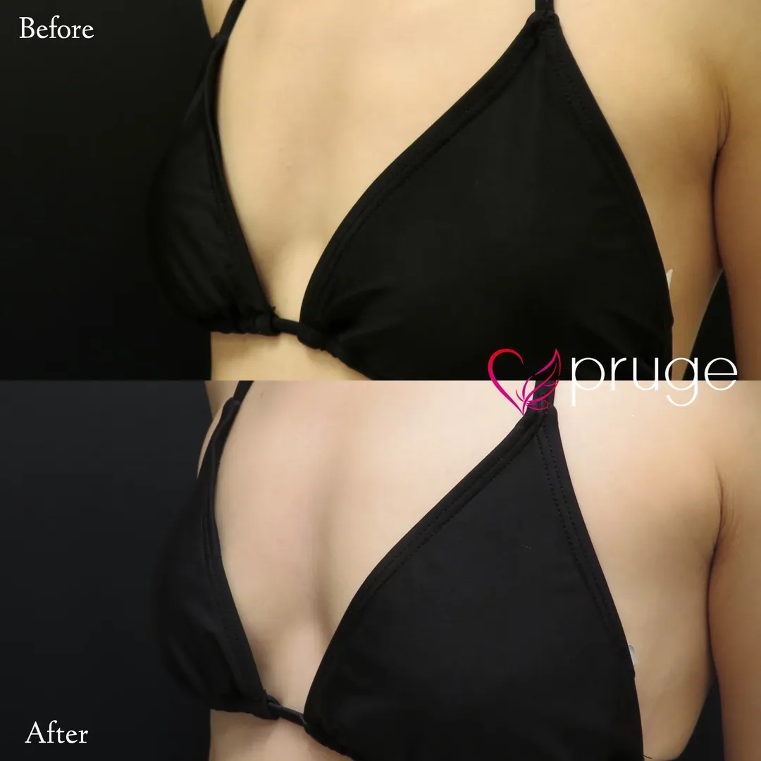 PRP注射（お胸）