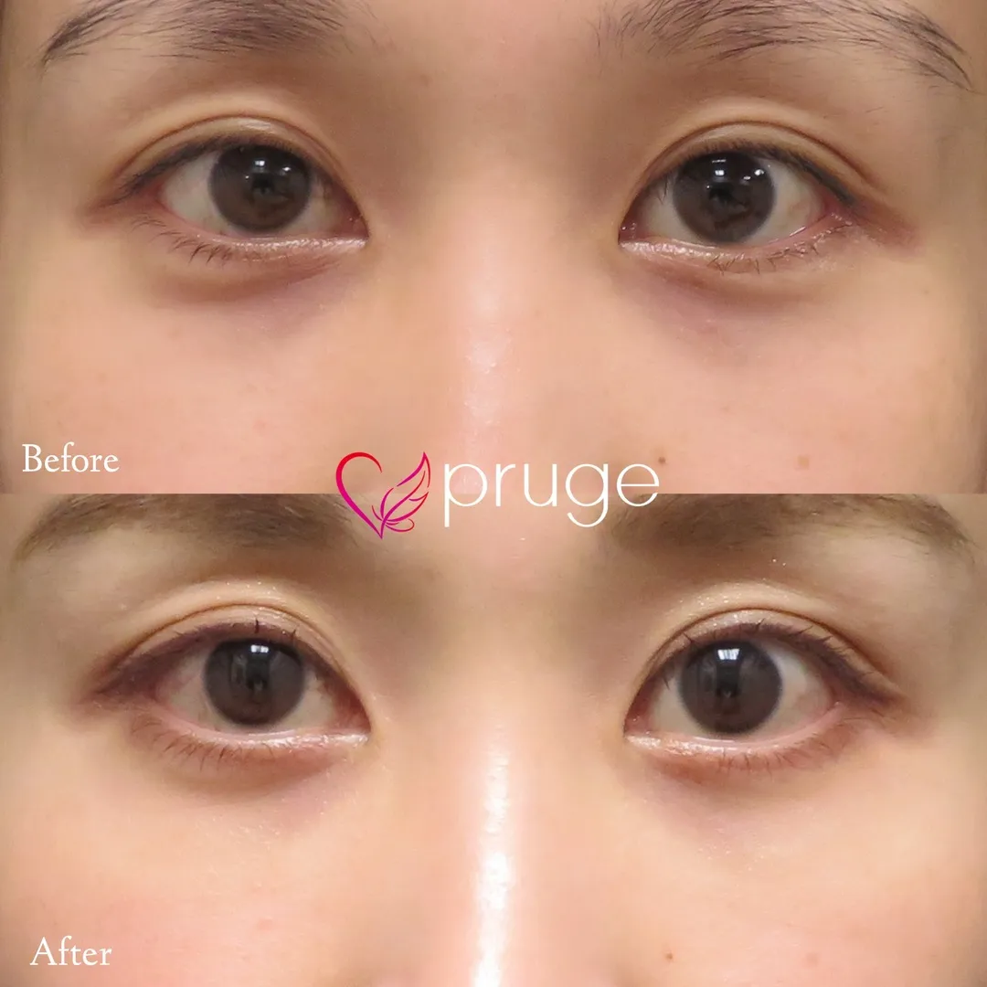 目の下のクマ・色素沈着