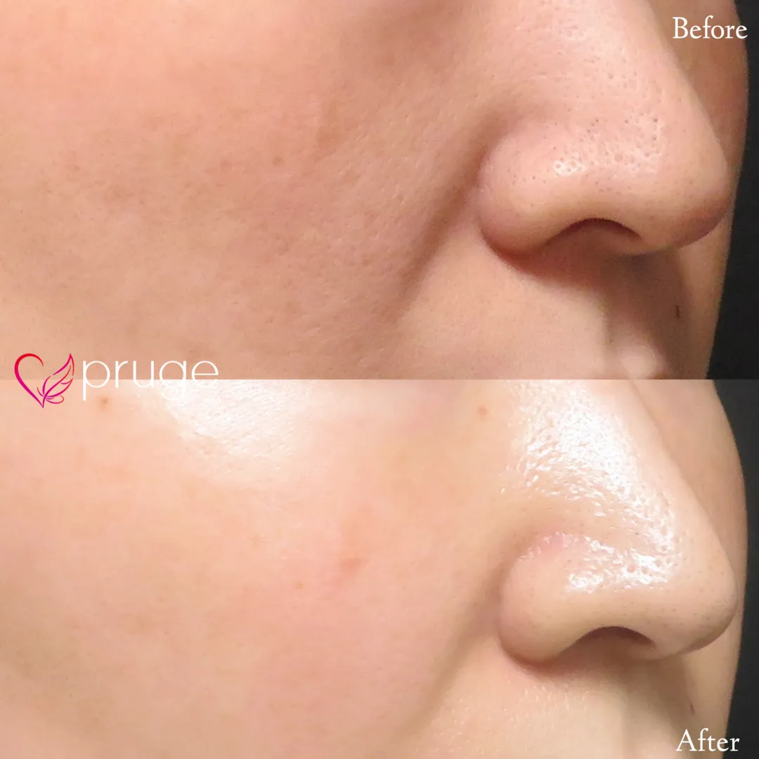 ヴァンパイアフェイシャル（全顔）