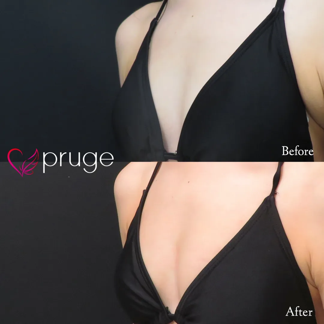 PRP注射（お胸）