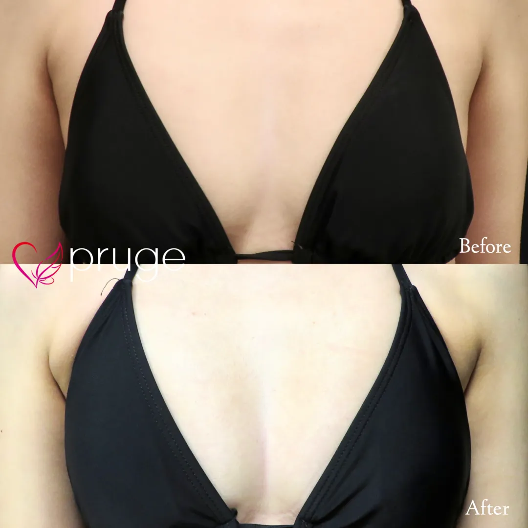 PRP注射（お胸）