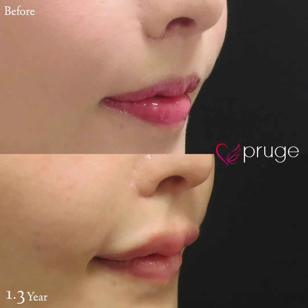 唇をふっくらさせたい