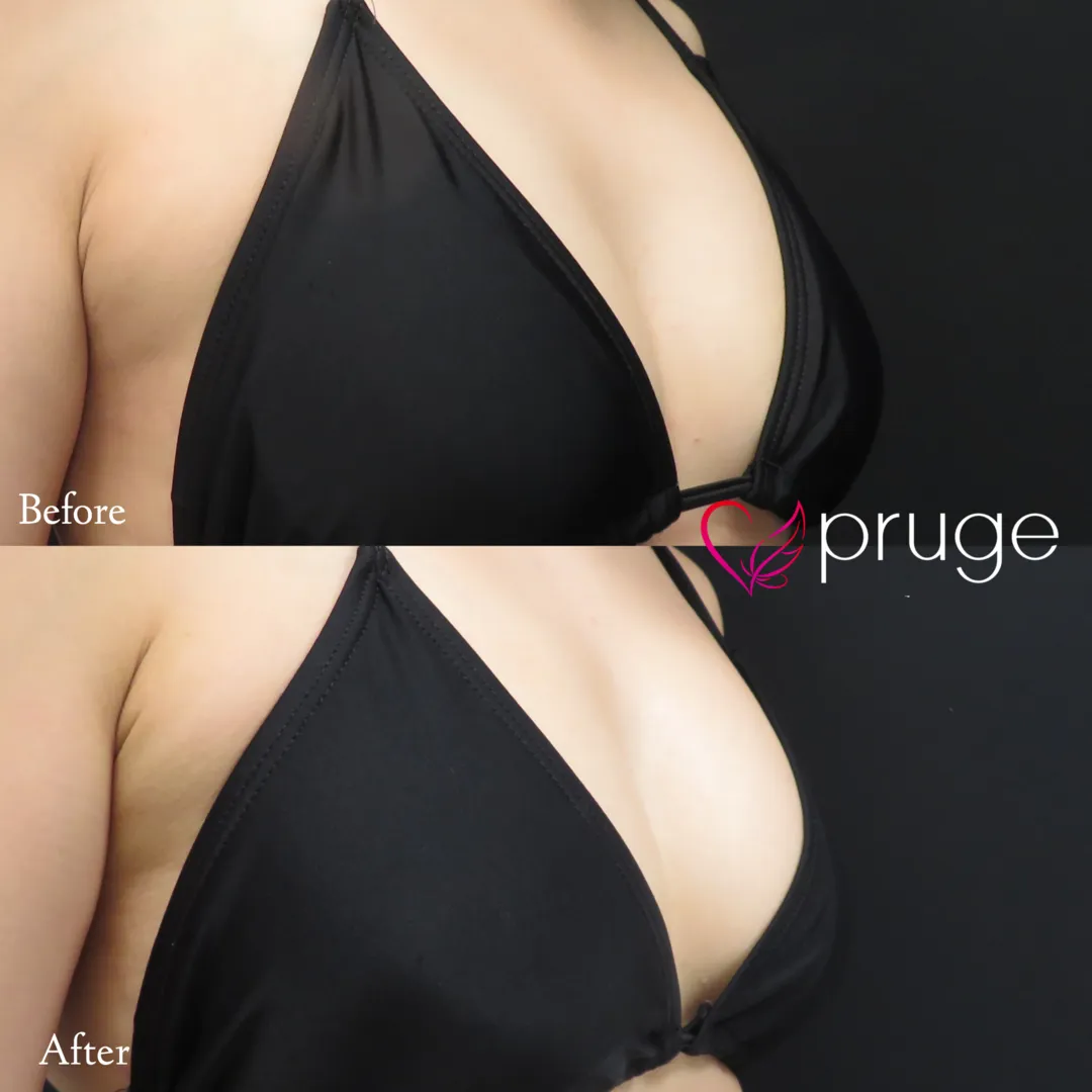 PRP注射（お胸）