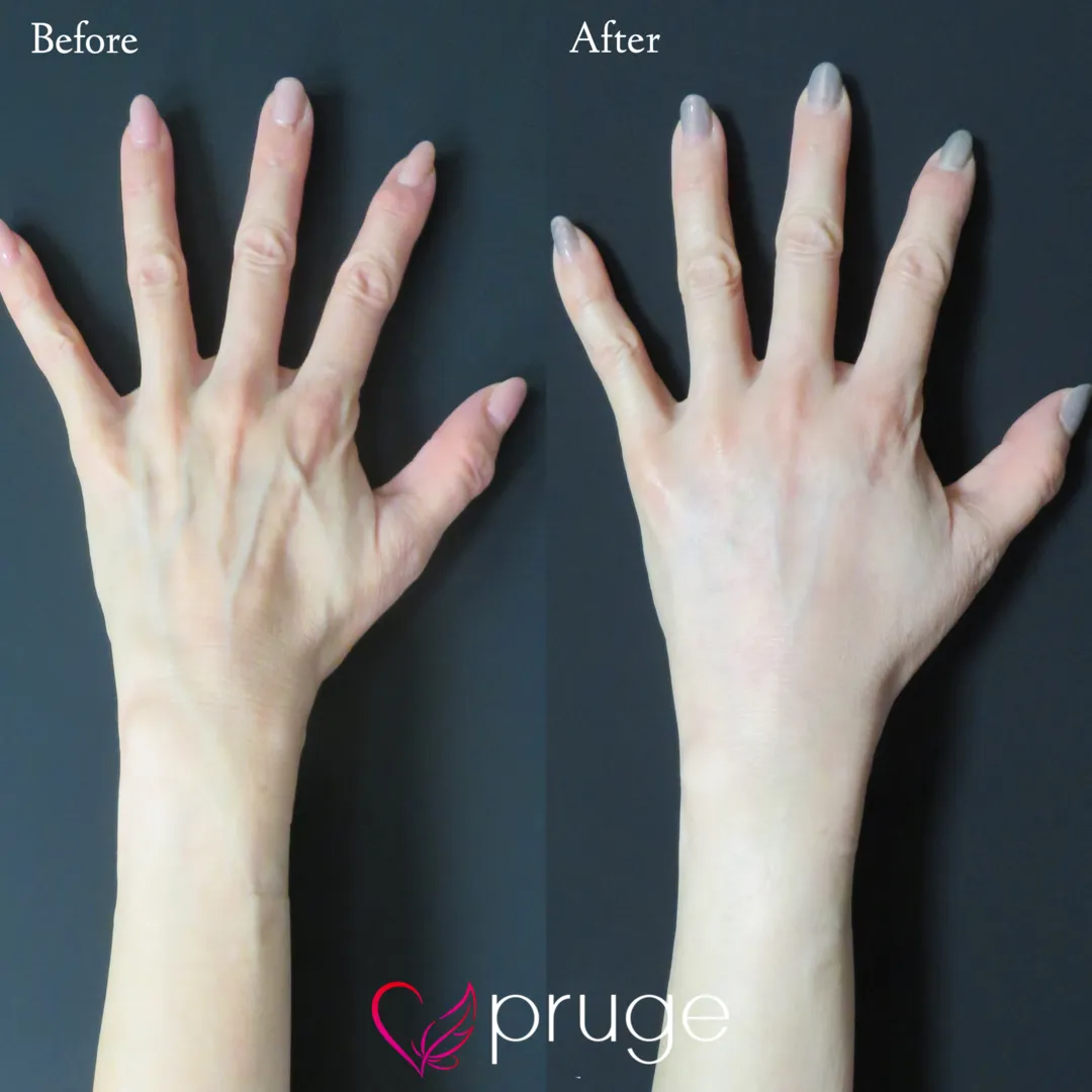 手の甲のスジ・血管