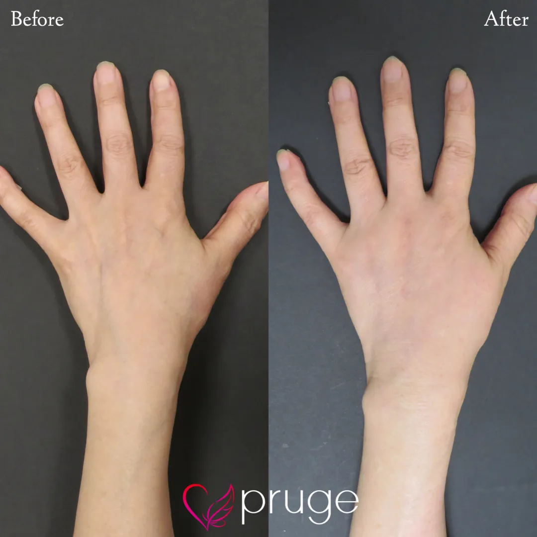 手の甲のスジ・乾燥