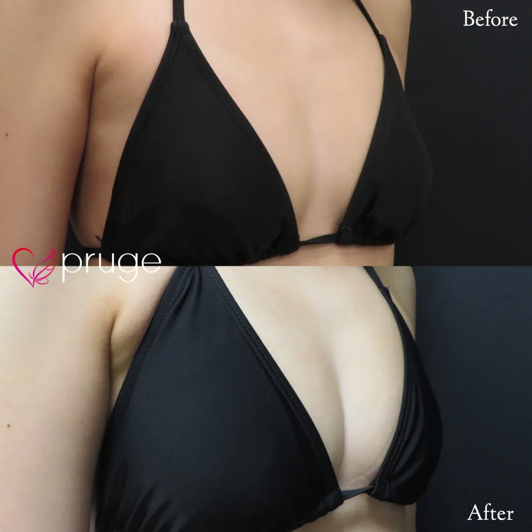 PRP注射（お胸）