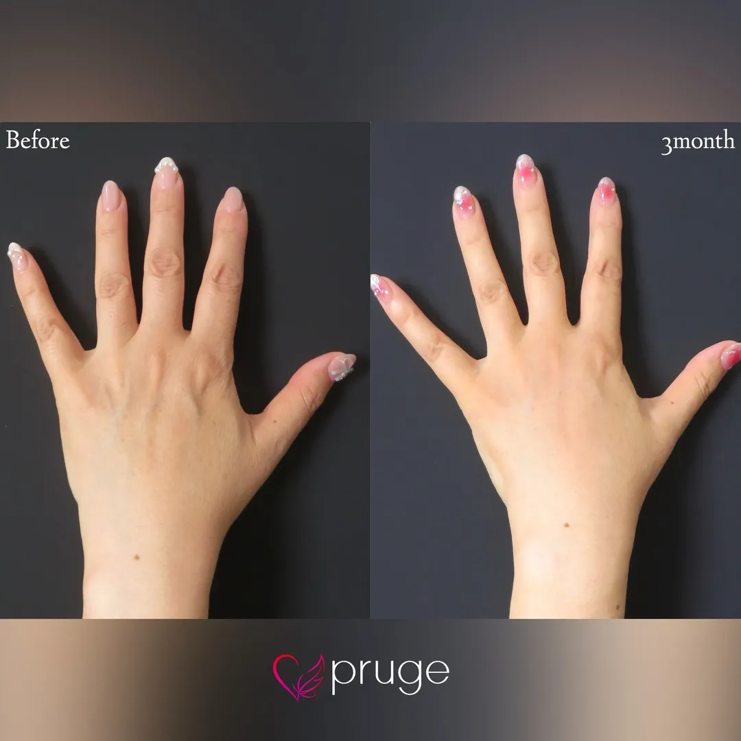 PRP注射(手の甲)