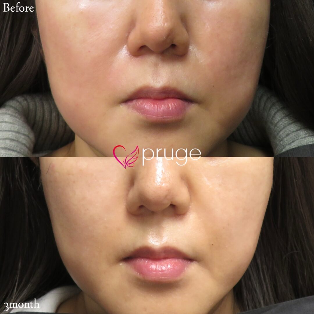 ほうれい線治療のPRP注射