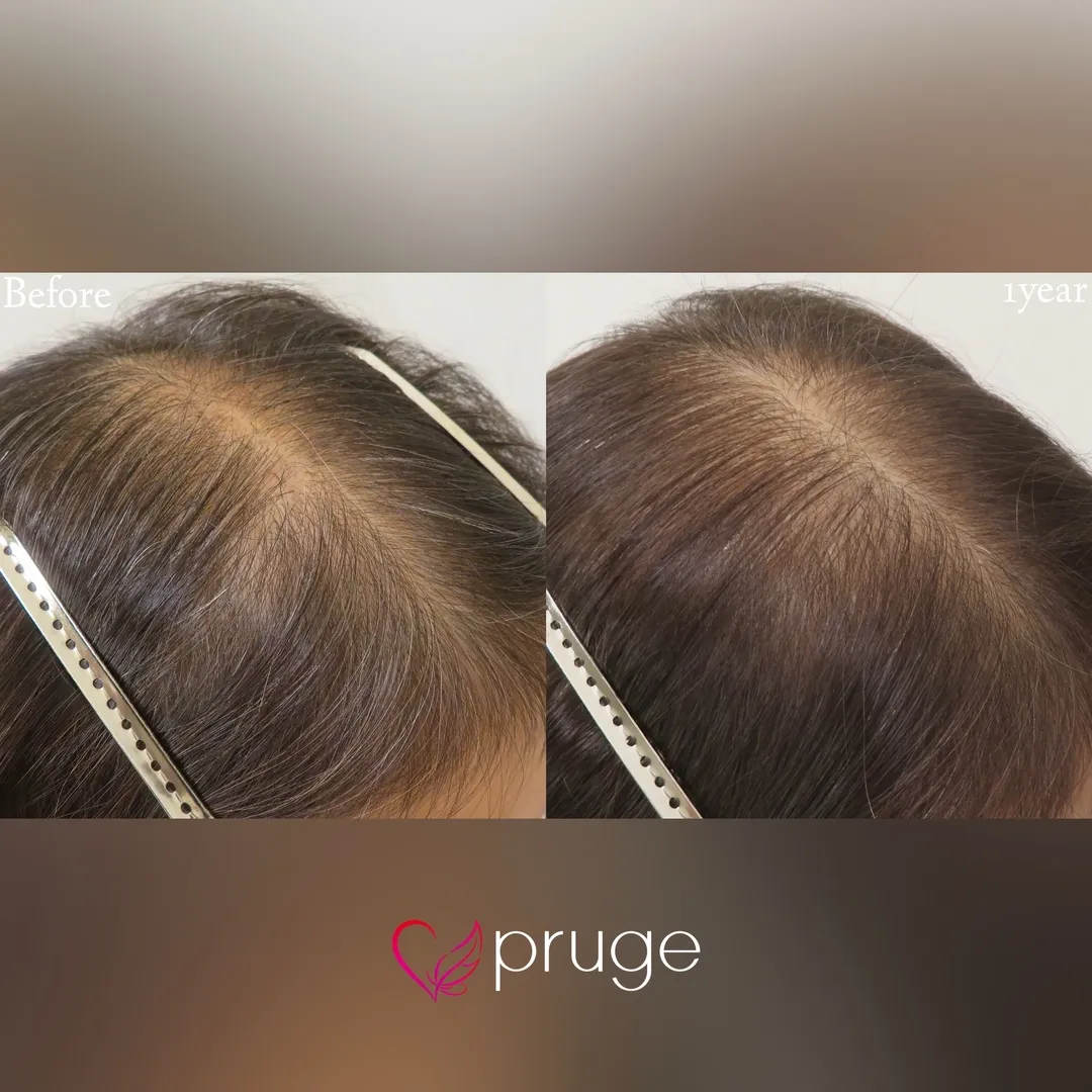 p-Scalp