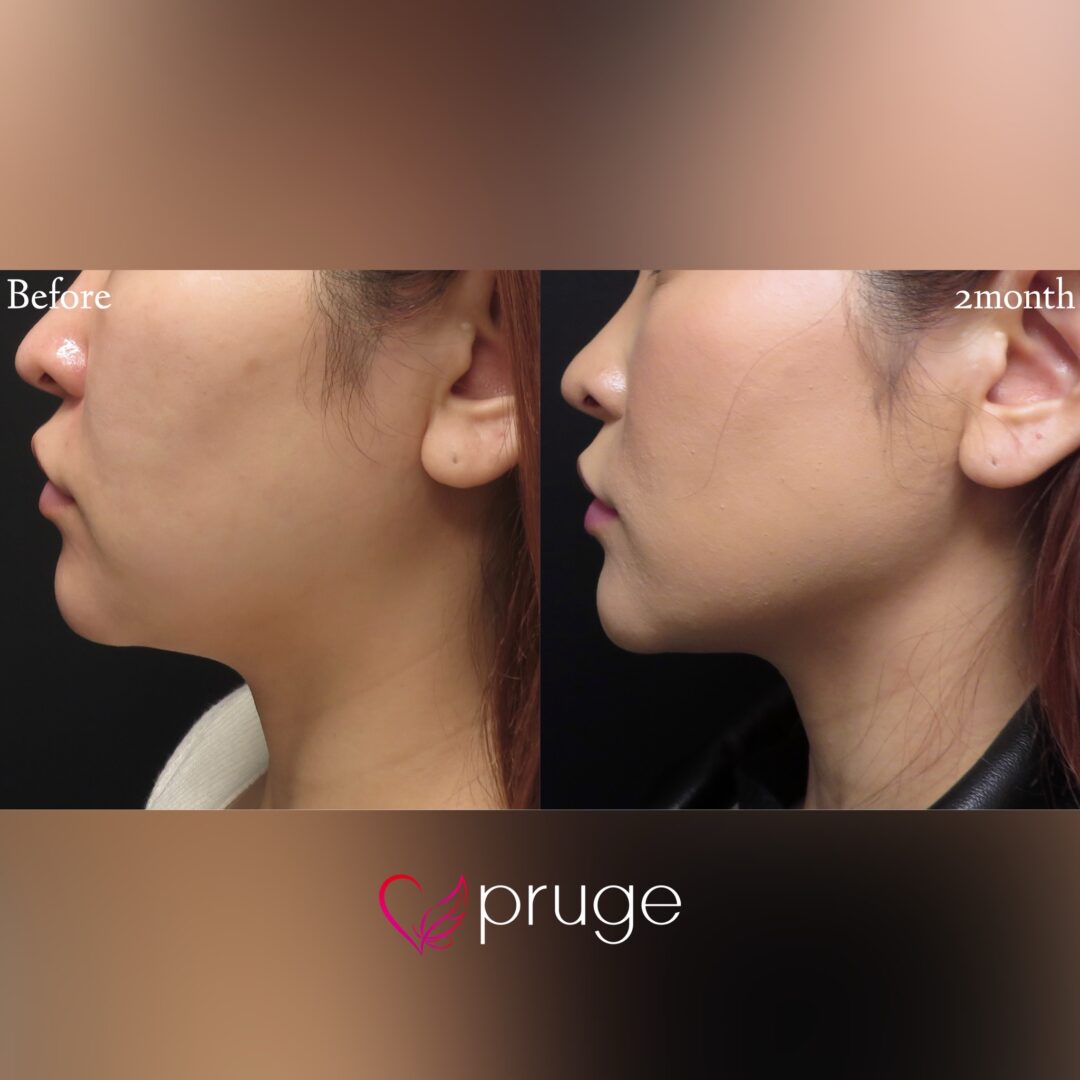 pスリム注射（フェイスライン、顎下、ほうれい線上）