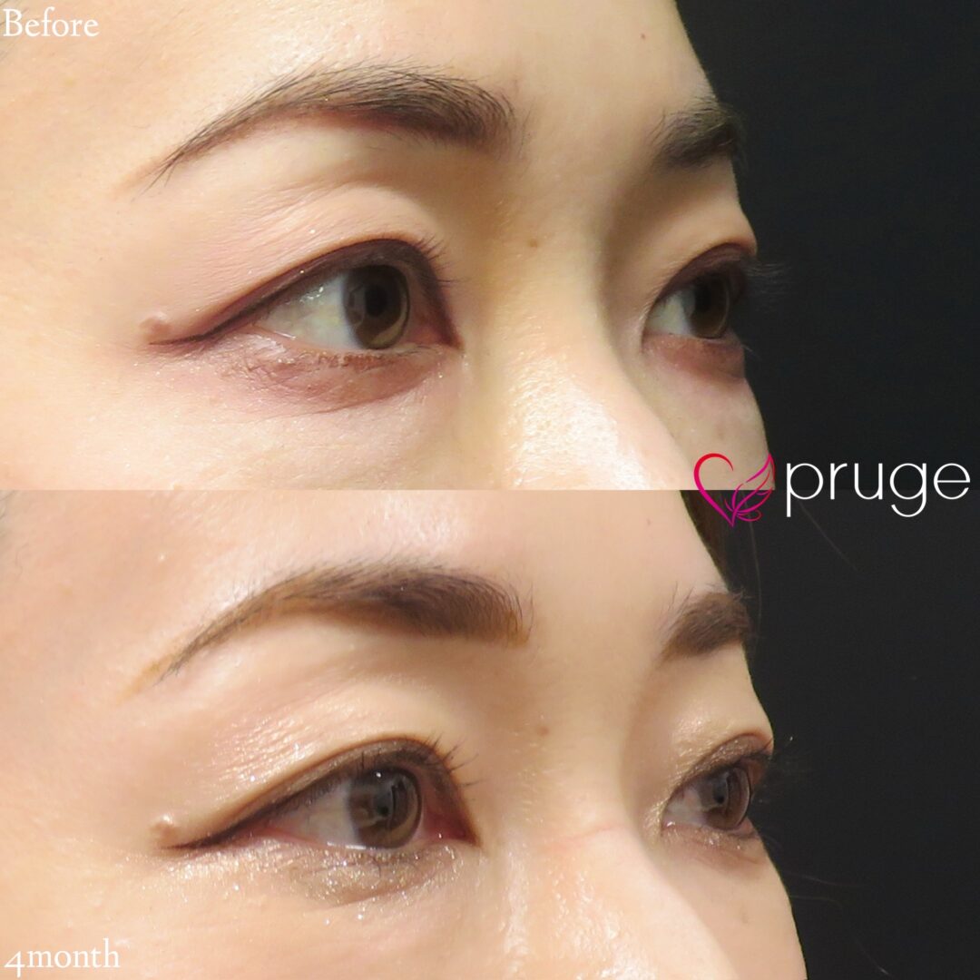 PRP注射（目の上）