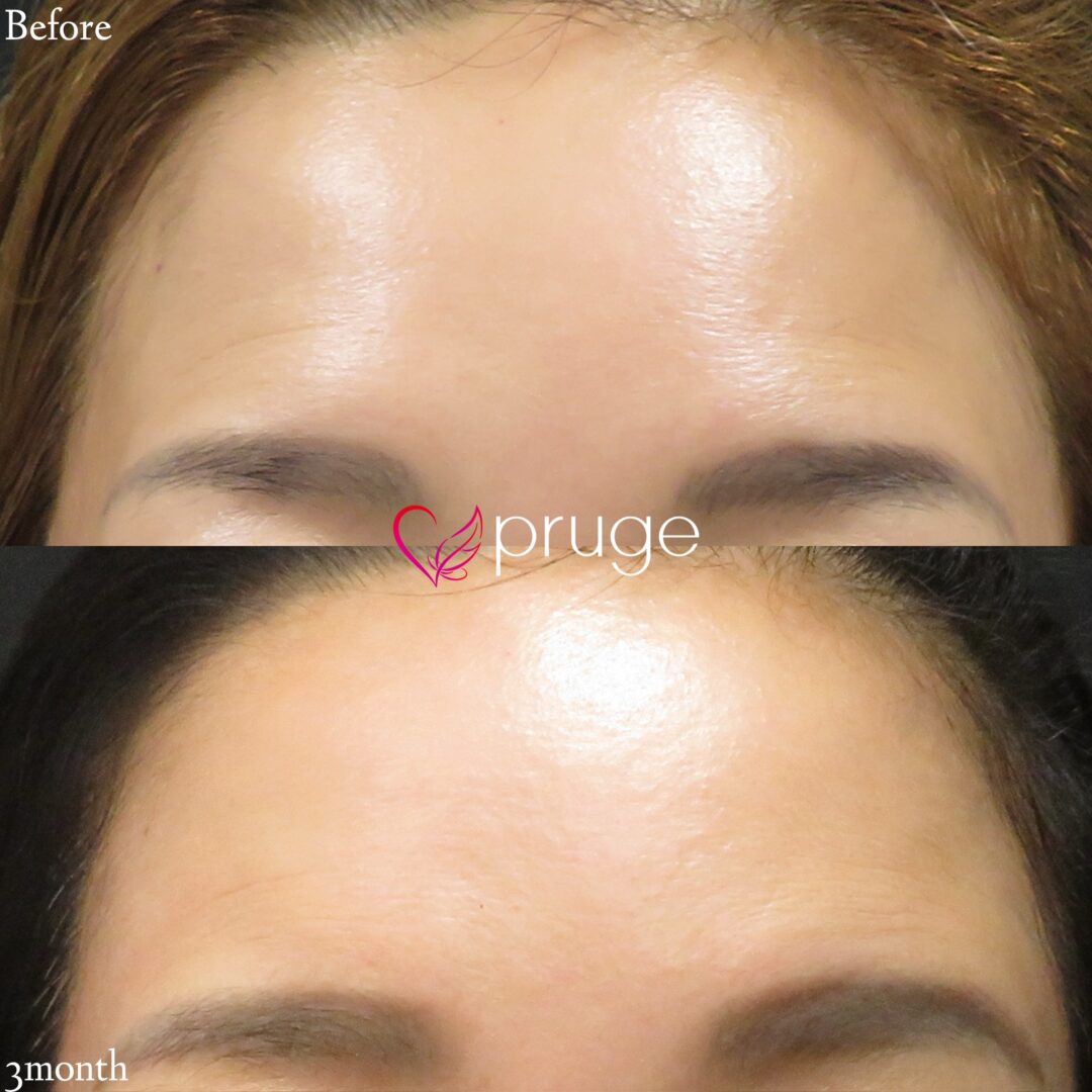 PRP注射(額のシワ)