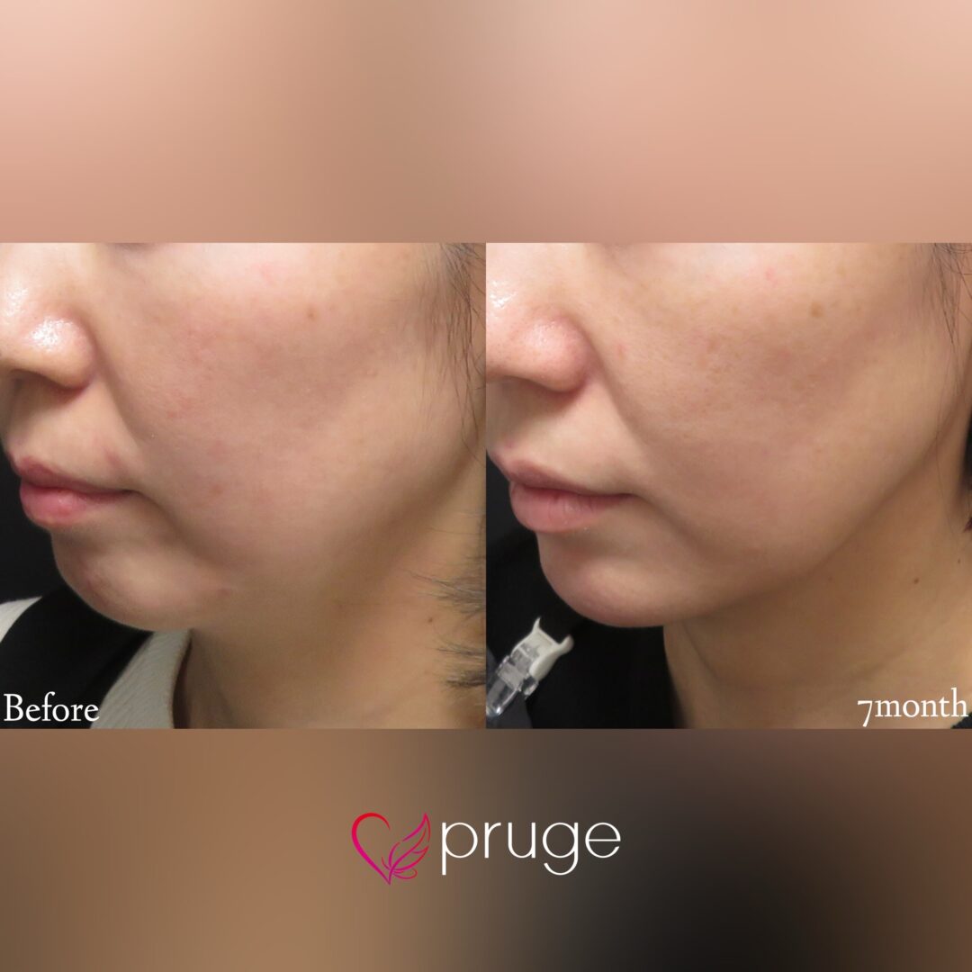 PRP注射(法令線、顎)･pスリム注射(フェイスライン)