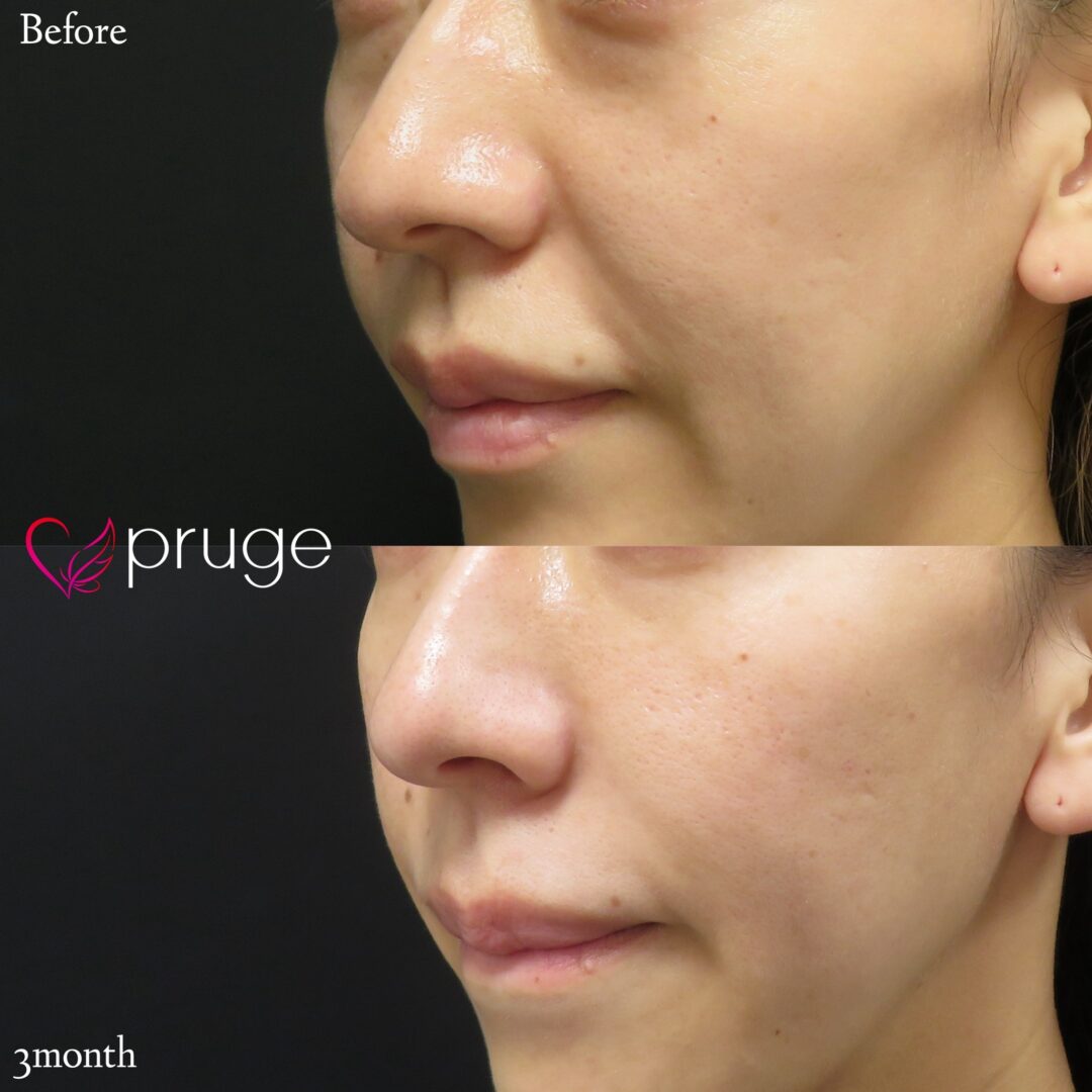 【PRP注射（目の下・法令線）】