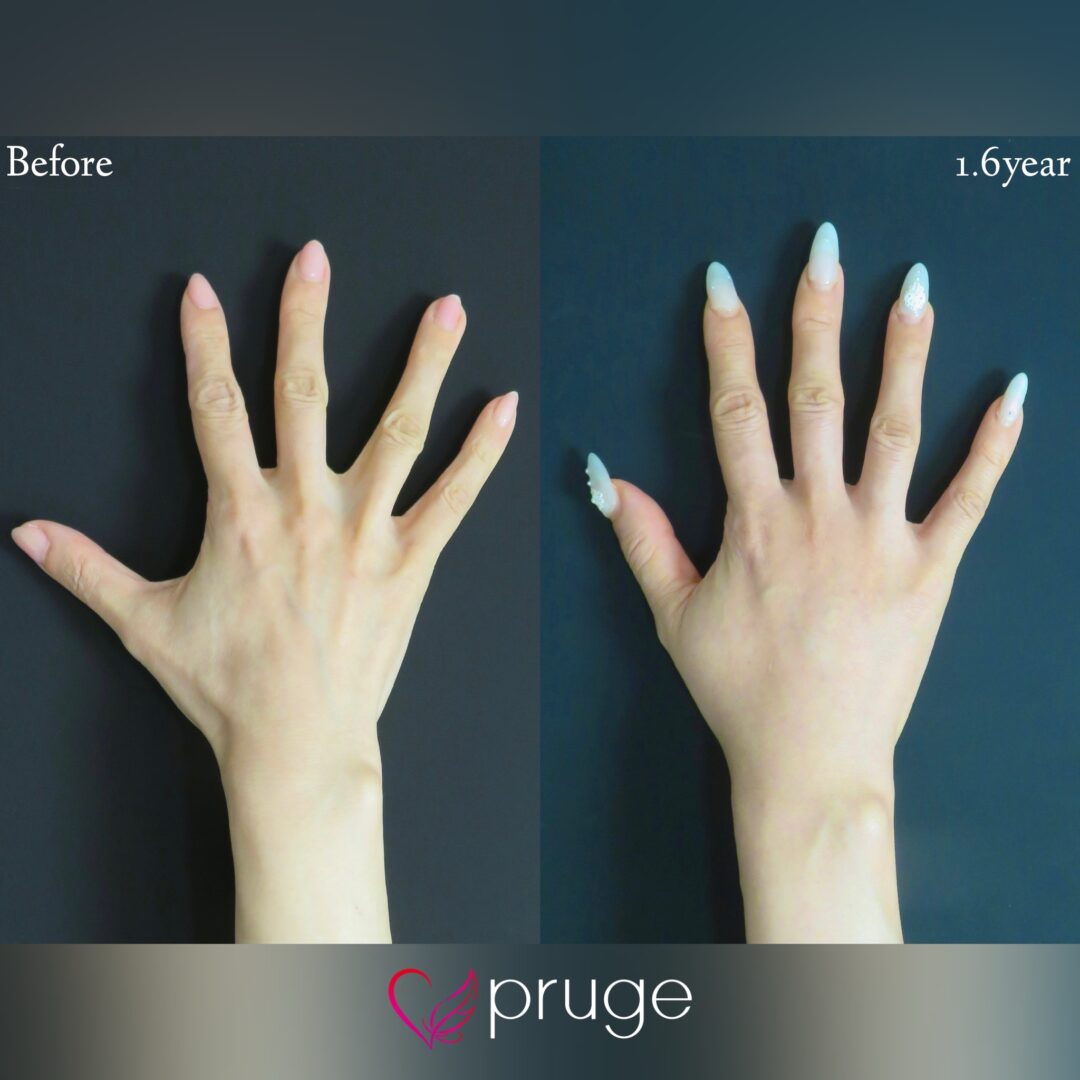 【PRP注射（手の甲）】