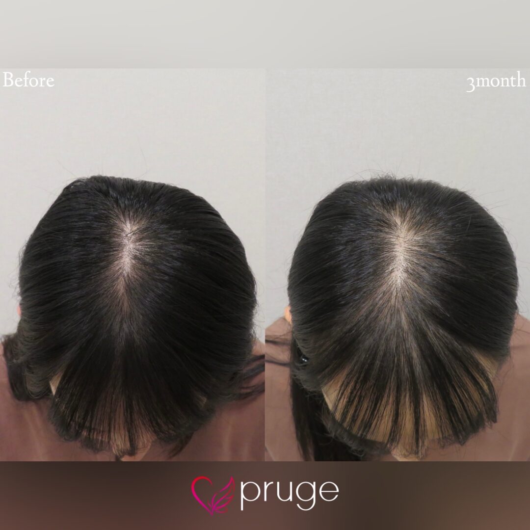 【PRP注射(後頭部形成術)】