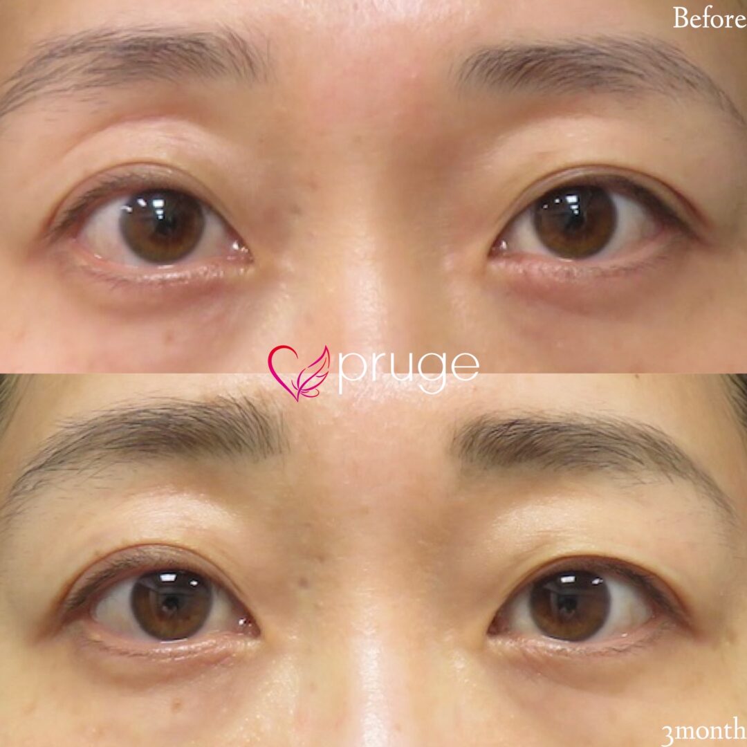 【PRP注射：目の上】