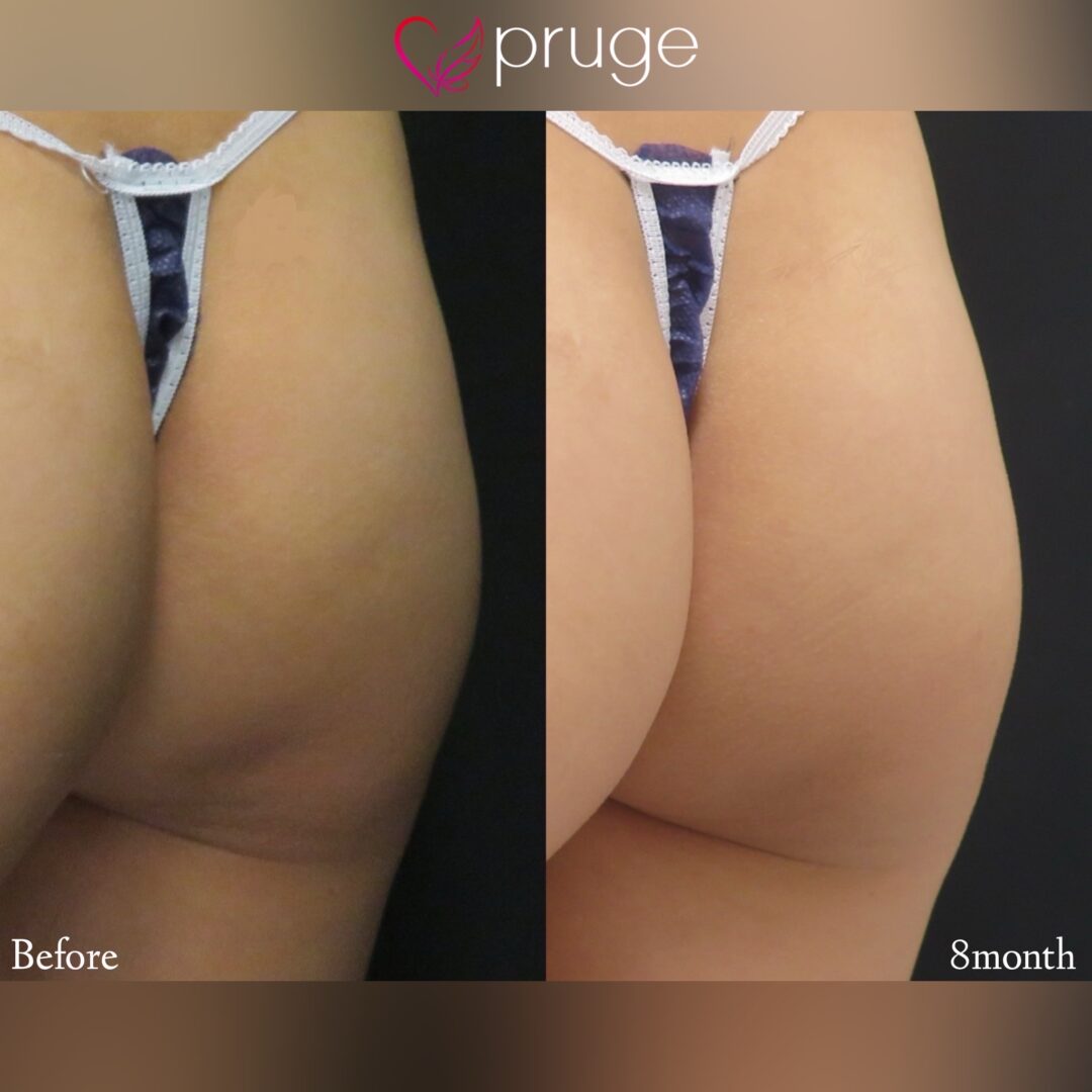 PRP注射によるヒップ形成