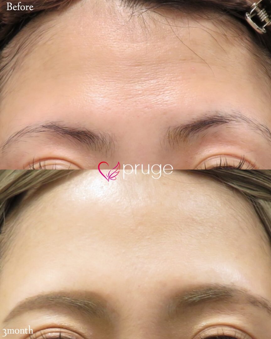 PRP注射(額のシワ)