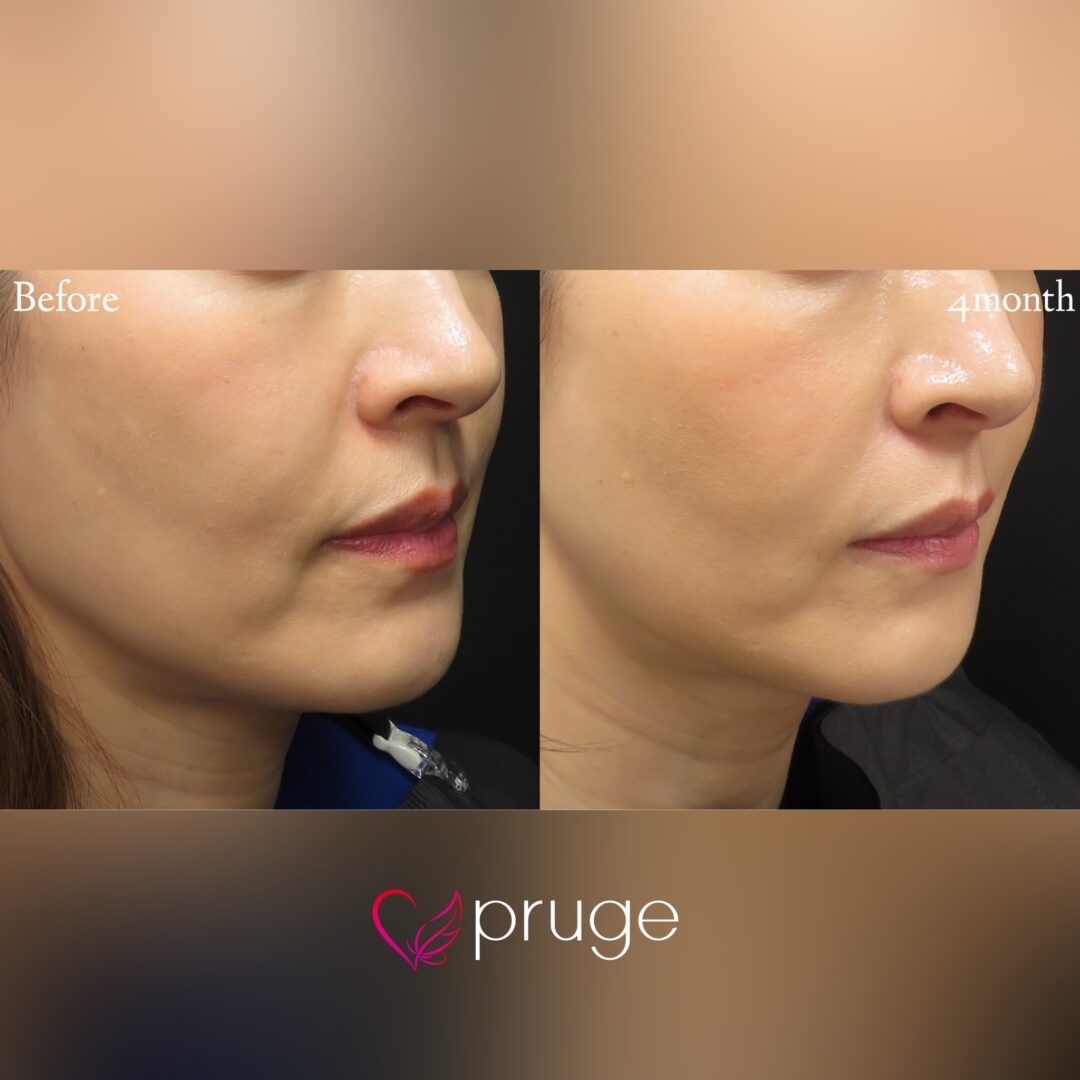 PRP注射（法令線・マリオネットライン）