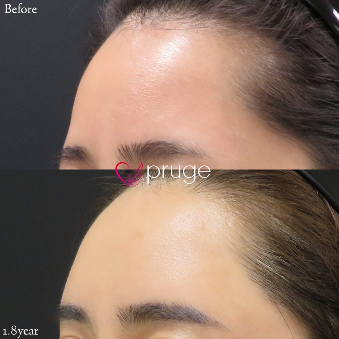PRP注射（ひたい・こめかみ丸み形成）